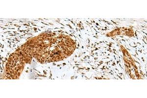 Immunohistochemistry of paraffin-embedded Human esophagus cancer tissue using HMG20A Polyclonal Antibody at dilution of 1:25(x200) (HMG20A anticorps)