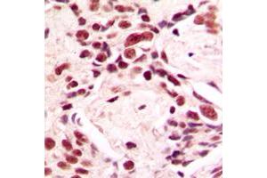 Immunohistochemical analysis of Lamin A/C staining in human breast cancer formalin fixed paraffin embedded tissue section. (Lamin A/C anticorps  (Center))