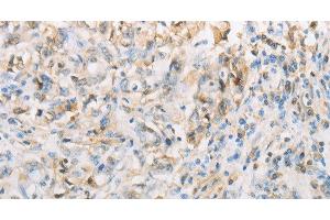 Immunohistochemistry of paraffin-embedded Human gasrtic cancer tissue using NPPC Polyclonal Antibody at dilution 1:70 (NPPC anticorps)