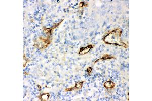 Anti- CD146 antibody, IHC(P) IHC(P): Human Lung Cancer Tissue (MCAM anticorps  (AA 59-401))