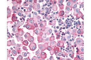 Anti-OR10J5 antibody IHC of human Skin, Melanoma.