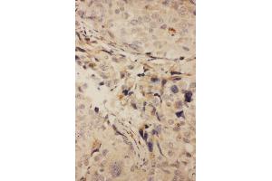 Anti-RANK antibody, IHC(P) IHC(P): Human Mammary Cancer Tissue
