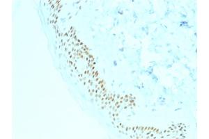 Formalin-fixed, paraffin-embedded human Basal Cell Carcinoma stained with p63 Mouse Monoclonal Antibody (TP63/2428). (p63 anticorps)