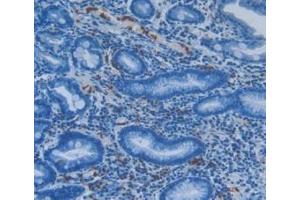 Detection of S100A8 in Human Stomach Cancer Tissue using Polyclonal Antibody to S100 Calcium Binding Protein A8 (S100A8)