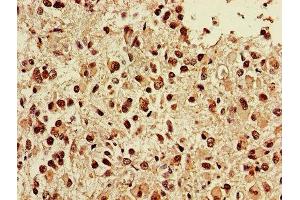 IHC image of ABIN7173856 diluted at 1:400 and staining in paraffin-embedded human glioma performed on a Leica BondTM system. (NGFR anticorps  (AA 277-391))