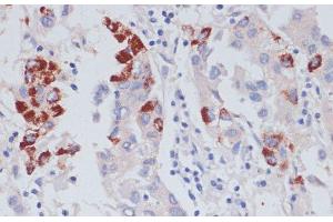 Immunohistochemistry of paraffin-embedded Human liver cancer using VASP Polyclonal Antibody at dilution of 1:100 (40x lens).