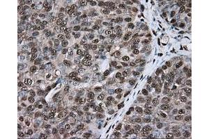 Immunohistochemical staining of paraffin-embedded colon tissue using anti-ERCC1 mouse monoclonal antibody. (ERCC1 anticorps)