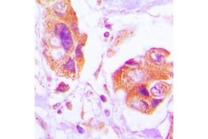 Immunohistochemical analysis of Filamin A (pS2152) staining in human lung cancer formalin fixed paraffin embedded tissue section. (Filamin A anticorps  (C-Term, pSer2152))