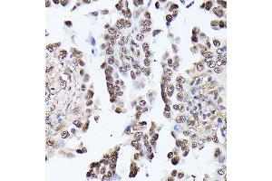 Immunohistochemistry of paraffin-embedded human lung cancer using TPI1 antibody (ABIN7270977) at dilution of 1:100 (40x lens).