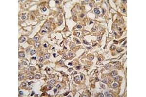 IHC analysis of FFPE human breast carcinoma tissue stained with MYLK3 antibody