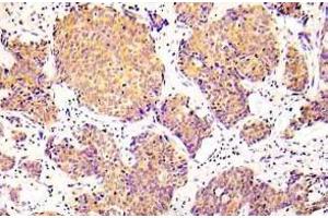 Immunohistochemistry (IHC) analyzes of p-COFILN1 (pSer3) antibody in paraffin-embedded human lung adenocarcinoma tissue. (Cofilin anticorps  (pSer3))