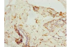 Immunohistochemistry of paraffin-embedded human breast cancer using ABIN7176183 at dilution of 1:100 (ZNF232 anticorps  (AA 1-417))