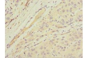 Immunohistochemistry of paraffin-embedded human liver cancer using ABIN7143763 at dilution of 1:100