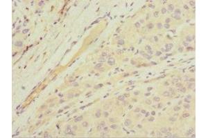 Immunohistochemistry of paraffin-embedded human liver cancer using ABIN7143763 at dilution of 1:100 (MGAT1 anticorps  (AA 156-445))