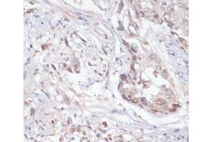 Immunohistochemistry of paraffin-embedded Human lung cancer using Phospho-Jak2(Y1007/1008) Polyclonal Antibody at dilution of 1:200 (40x lens). (JAK2 anticorps  (pTyr1007, pTyr1008))