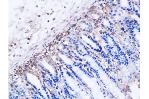 Formalin-fixed and paraffin embedded ovarian cancer xenograft labeled with Anti-DBC2 receptor Polyclonal Antibody, Unconjugated  followed by conjugation to the secondary antibody and DAB staining