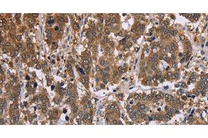 Immunohistochemistry of paraffin-embedded Human liver cancer tissue using FBP2 Polyclonal Antibody at dilution 1:40 (FBP2 anticorps)