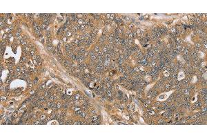 Immunohistochemistry of paraffin-embedded Human ovarian cancer using PTPN20 Polyclonal Antibody at dilution of 1:30 (PTPN20 anticorps)