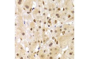 Immunohistochemistry of paraffin-embedded human liver cancer using HNRNPA1 Antibody (ABIN5975570) at dilution of 1/100 (40x lens). (HNRNPA1 anticorps)