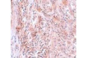 Immunohistochemistry of BCAS2 in human breast carcinoma with BCAS2 antibody at 5 μg/ml.