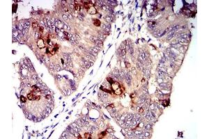 Immunohistochemical analysis of paraffin-embedded rectum cancer tissues using CD1C mouse mAb with DAB staining.