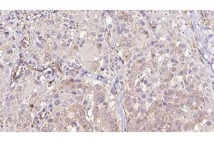 ABIN6273315 at 1/100 staining Human thyroid cancer tissue by IHC-P. (SEC63 anticorps  (C-Term))