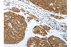The image on the left is immunohistochemistry of paraffin-embedded Human liver cancer tissue using ABIN7192428(SLC22A3 Antibody) at dilution 1/25, on the right is treated with synthetic peptide. (SLC22A3 anticorps)