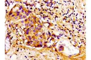 Immunohistochemistry of paraffin-embedded human breast cancer using ABIN7148919 at dilution of 1:100