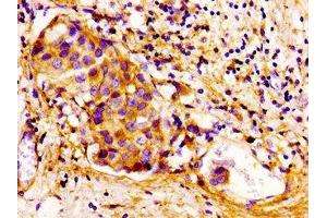 Immunohistochemistry of paraffin-embedded human breast cancer using ABIN7148919 at dilution of 1:100 (CDKN3 anticorps  (AA 1-172))