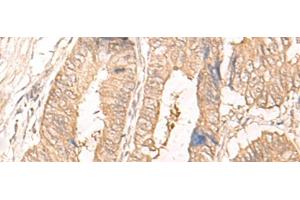 Immunohistochemistry of paraffin-embedded Human colorectal cancer tissue using IL24 Polyclonal Antibody at dilution of 1:30(x200) (IL-24 anticorps)
