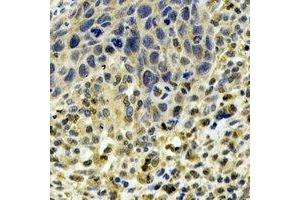 Immunohistochemical analysis of ABO staining in human esophageal cancer formalin fixed paraffin embedded tissue section. (ABO anticorps)