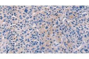 Immunohistochemistry of paraffin-embedded Human liver cancer tissue using CD5L Polyclonal Antibody at dilution 1:40 (CD5L anticorps)