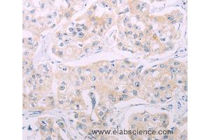 Immunohistochemistry of Human breast cancer using ADCY7 Polyclonal Antibody at dilution of 1:60 (ADCY7 anticorps)