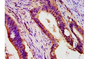 IHC image of ABIN7162997 diluted at 1:400 and staining in paraffin-embedded human colon cancer performed on a Leica BondTM system.