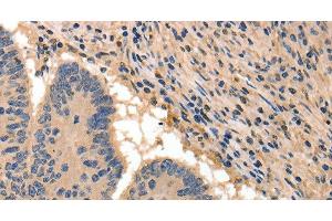 Immunohistochemistry of paraffin-embedded Human colon cancer tissue using BAIAP2 Polyclonal Antibody at dilution 1:50 (BAIAP2 anticorps)