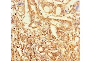 Immunohistochemistry of paraffin-embedded human pancreatic cancer using ABIN7176457 at dilution of 1:100 (ZNF627 anticorps  (AA 1-300))
