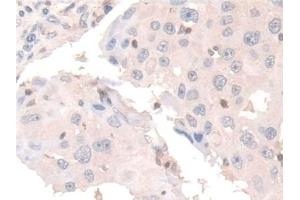 Detection of COTL1 in Human Breast cancer Tissue using Polyclonal Antibody to Coactosin Like Protein 1 (COTL1)