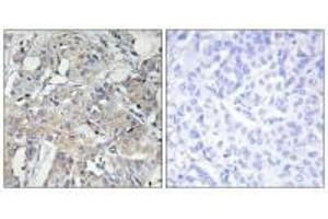 Immunohistochemistry analysis of paraffin-embedded human breast carcinoma tissue using Collagen VI α3 antibody. (COL6a3 anticorps)