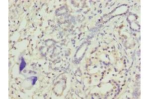 Immunohistochemistry of paraffin-embedded human pancreatic cancer using ABIN7172914 at dilution of 1:100 (TRAM2 anticorps  (AA 316-370))