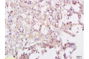 Formalin-fixed and paraffin embedded human breast carcinoma labeled with Anti eIF3A Polyclonal Antibody, Unconjugated (ABIN704891) at 1:200 followed by conjugation to the secondary antibody and DAB staining (UBR1 anticorps  (AA 801-900))