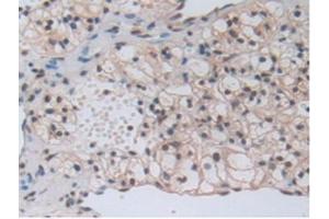 IHC-P analysis of Human Kidney Cancer Tissue, with DAB staining. (beta-Thromboglobulin anticorps  (AA 59-128))