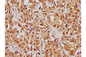 IHC image of nphHU diluted at 1:8 and staining in paraffin-embedded human liver cancer performed on a Leica BondTM system. (HIST1H1E anticorps  (AA 21-33))