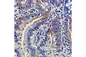 Immunohistochemical analysis of Ribophorin-1 staining in human colon cancer formalin fixed paraffin embedded tissue section. (RPN1 anticorps)