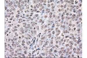 Immunohistochemical staining of paraffin-embedded Adenocarcinoma of Human colon tissue using anti-BAT1 mouse monoclonal antibody. (BAT1 anticorps)