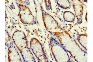 Immunohistochemistry of paraffin-embedded human gastric cancer using ABIN7166961 at dilution of 1:100 (RABGAP1L anticorps  (Isoform 10))