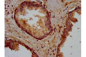 IHC image of ABIN7157575 diluted at 1:400 and staining in paraffin-embedded human prostate cancer performed on a Leica BondTM system.