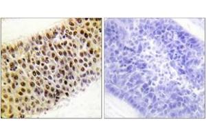 Immunohistochemistry analysis of paraffin-embedded human liver carcinoma tissue, using TIP60 (Ab-86) Antibody. (KAT5 anticorps  (AA 52-101))