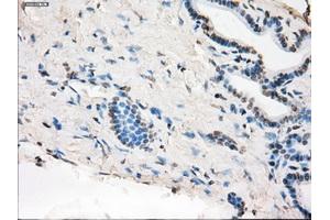 Immunohistochemical staining of paraffin-embedded Adenocarcinoma of colon tissue using anti-MAP2K1 mouse monoclonal antibody. (MEK1 anticorps)
