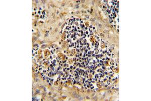 Formalin-fixed and paraffin-embedded human kidney carcionma reacted with ROR2 Antibody (N-term), which was peroxidase-conjugated to the secondary antibody, followed by DAB staining.