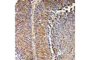 Immunohistochemical analysis of SH2D2A staining in human liver cancer formalin fixed paraffin embedded tissue section. (SH2D2A anticorps)